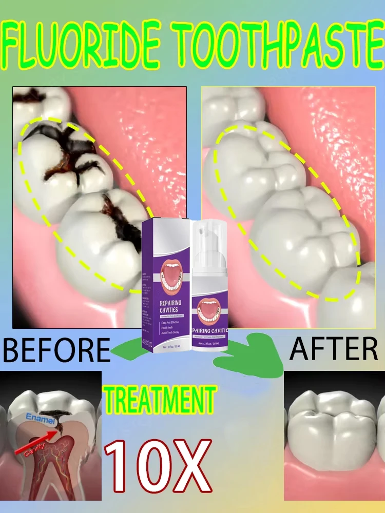 Teeth Whitening Best - 과학적인 공동 수리, 공동 제거, 플라크