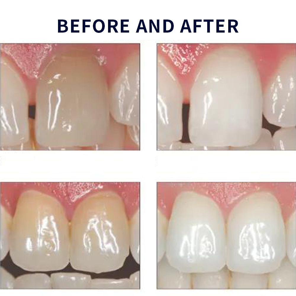 유백광 미백 20% PF 20 16 젤 키트, 초강력  - Teeth Whitening With Peroxide 리뷰 및 가격