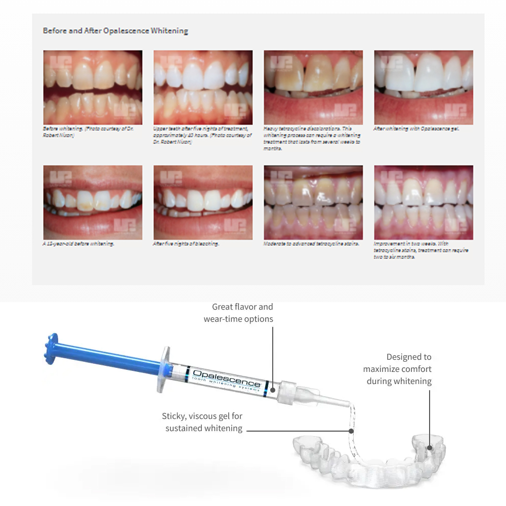 유백광 미백 20% PF 20 16 젤 키트, 초강력  - Teeth Whitening With Peroxide 리뷰 및 가격