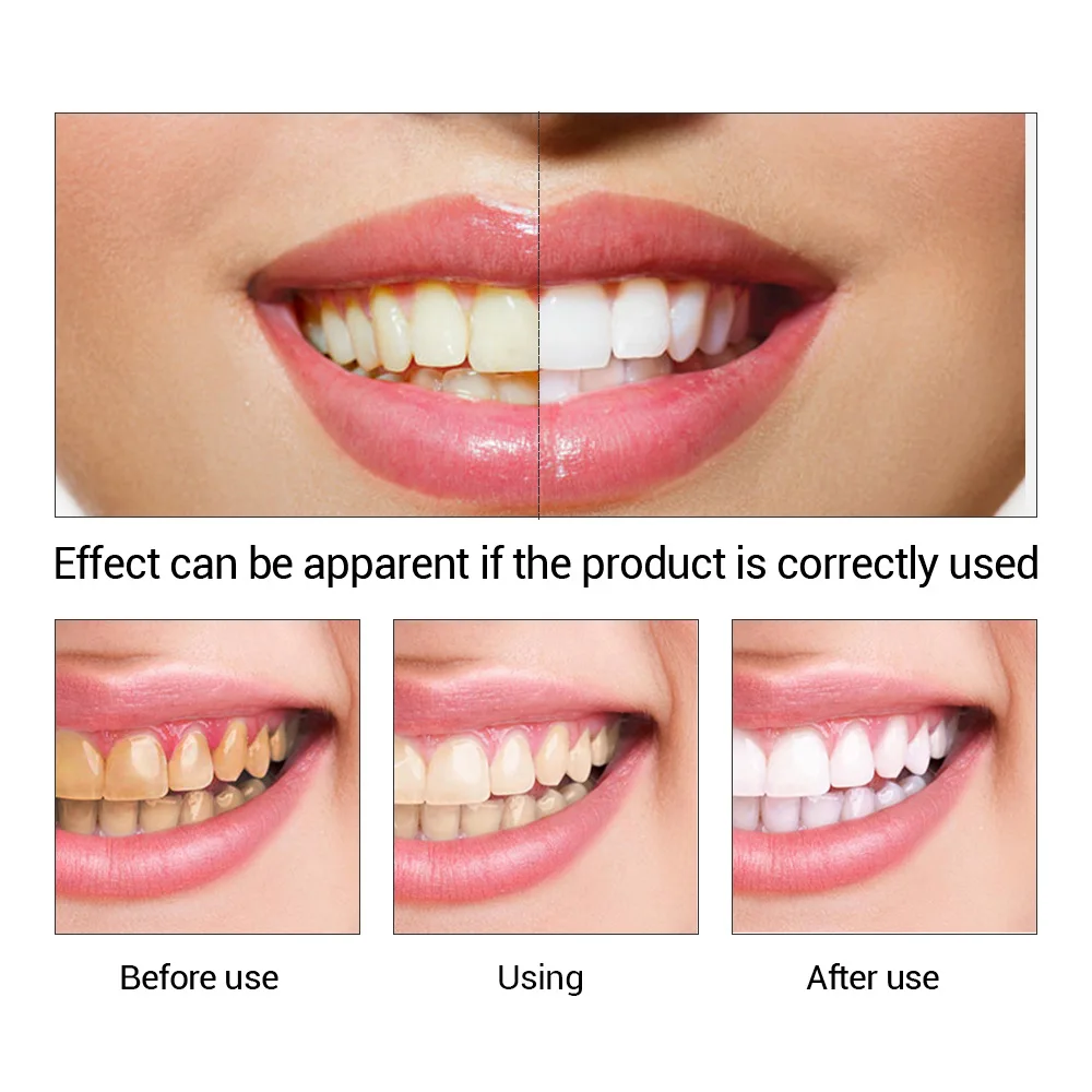 FTEENPLY 치아 미백 에센스 파우더 구강 위생 청 - Teeth Whitening Best 리뷰 및 가격