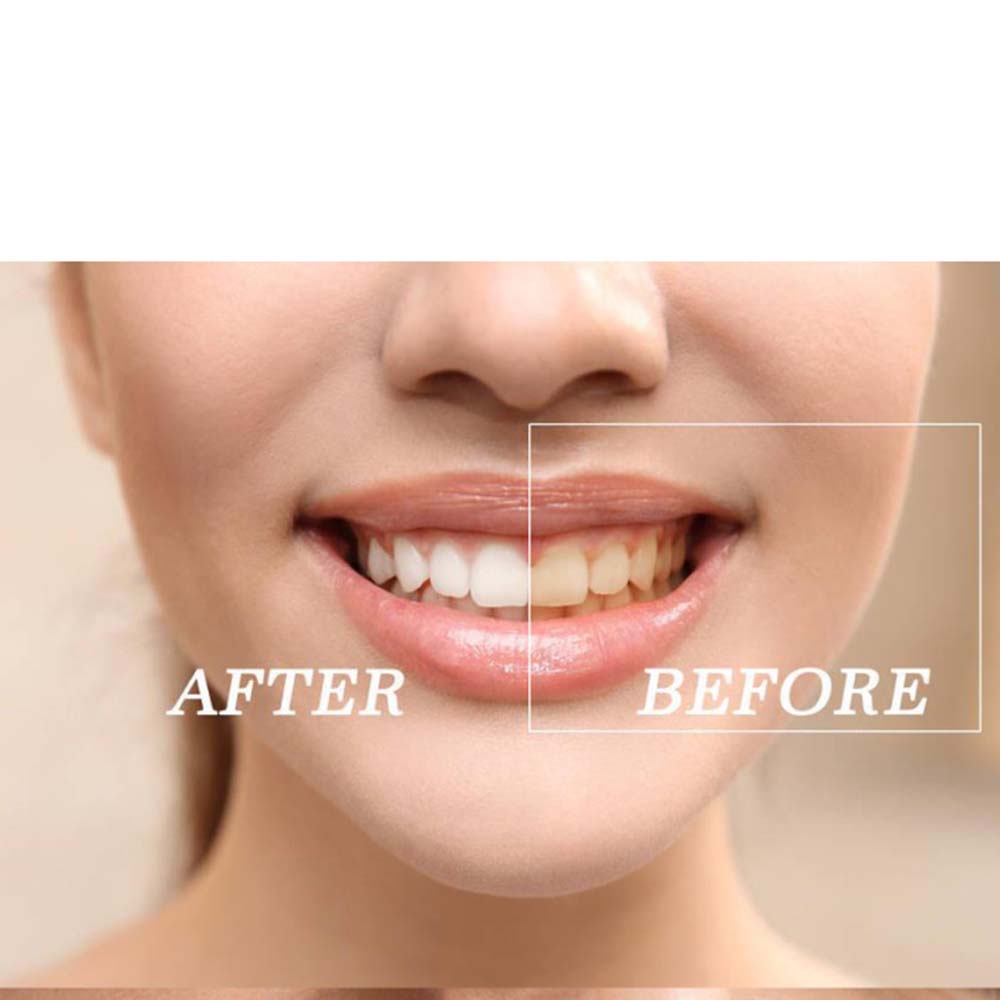 최고 품질의 과산화물 치아 미백 젤 키트 표백 시스템  - Teeth Whitening With Peroxide 리뷰 및 가격