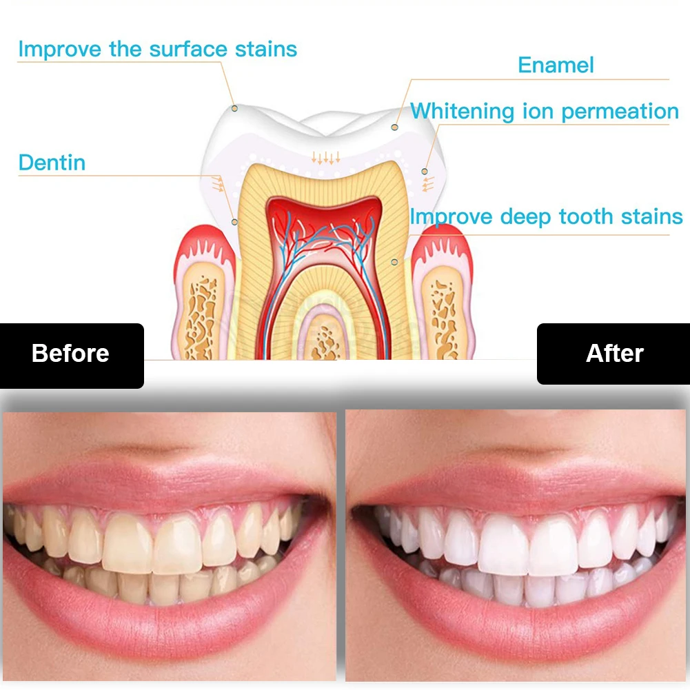 치과 치아 미백 키트 미니 16 LED 콜드 라이트 3 - Teeth Whitening With Blue Light 리뷰 및 가격