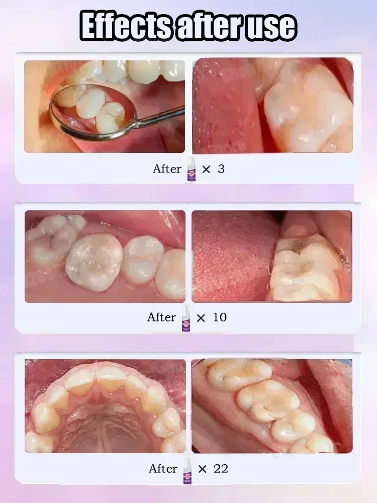 과학적인 공동 수리, 공동 제거, 플라크 청소, 치아  - Teeth Whitening Best 리뷰 및 가격